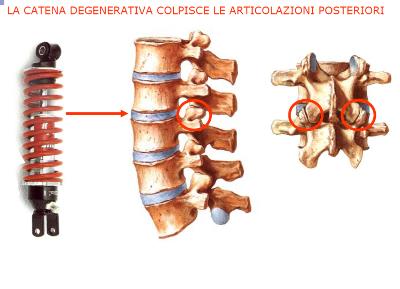 Fig 1 Dolore schiena lombare